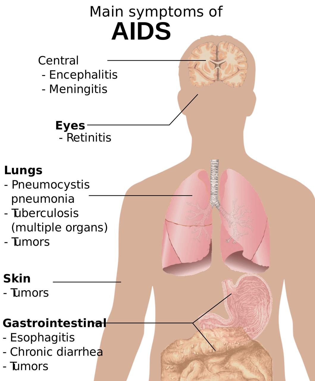 Health Lesson Plans: All About HIV and AIDS