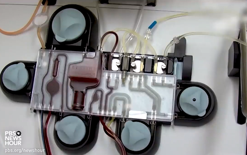 How Plasma Therapy May Help COVID-19 Patients